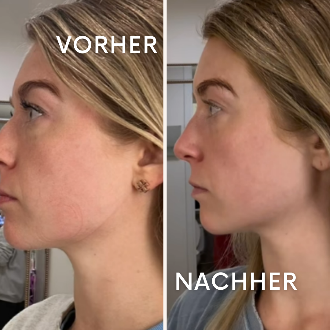 VellaLift: Sichtbar straffere Gesichtszüge
